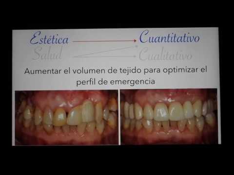 Episodio II Red Sessions: Relevancia clínica de los Tejidos Blandos  en terapia de Implantes