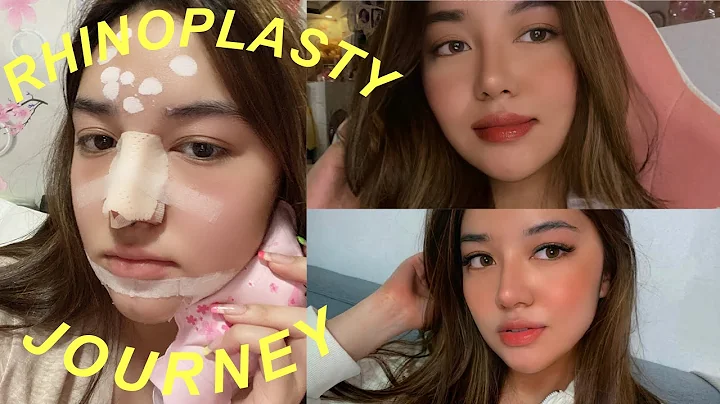 MY RHINOPLASTY JOURNEY (2 WEEKS POST-OP) | Andrea ...
