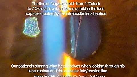 "I see a line of light through my lens implant!" Posterior capsular fold treatment-YAG capsulotomy.