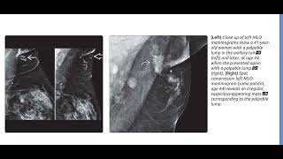 Breast imaging ultrasound /radiology/sonology @RadiologyChannel