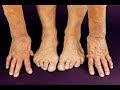 #มีอาการโรคข้ออักเสบรูมาตอยด์(Rheumatoid arthritis)ปรึกษาปัญหาสุขภาพโทร/line 080-607-1749