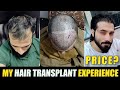 My 2 Years Hair Transplant Result Timeline in Pakistan | Before and After Photos