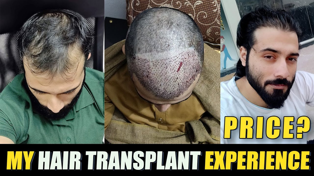My 2 Years Hair Transplant Result Timeline in Pakistan | Before and After  Photos - YouTube