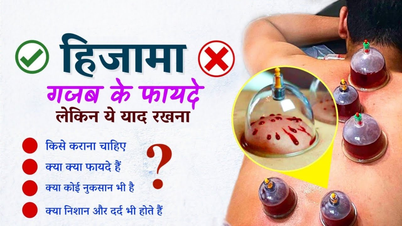 hijama-therapy-ke-fayde-in-hindi