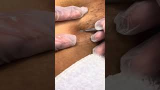 Ingrown hair blackhead removal after a bikini wax #hairremoval #waxing #fyp #ingrownhair #youtube