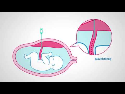 Video: Ventriculomegalie Bij De Foetus - Oorzaken, Behandeling, Symptomen