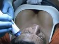 Thermage CPT - Rejuvenecimiento Facial y Lifting sin Cirugia-sh