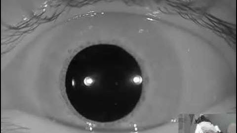 Right Horizontal Cupulolithiasis