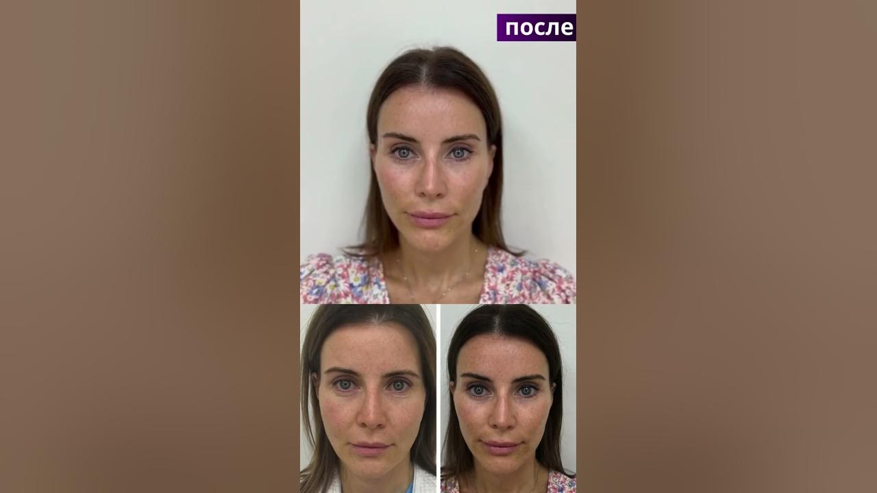 Лифтинг лица, подтяжка лица, пластика лица, омоложение - YouTube