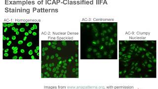 Antinuclear Antibody Testing