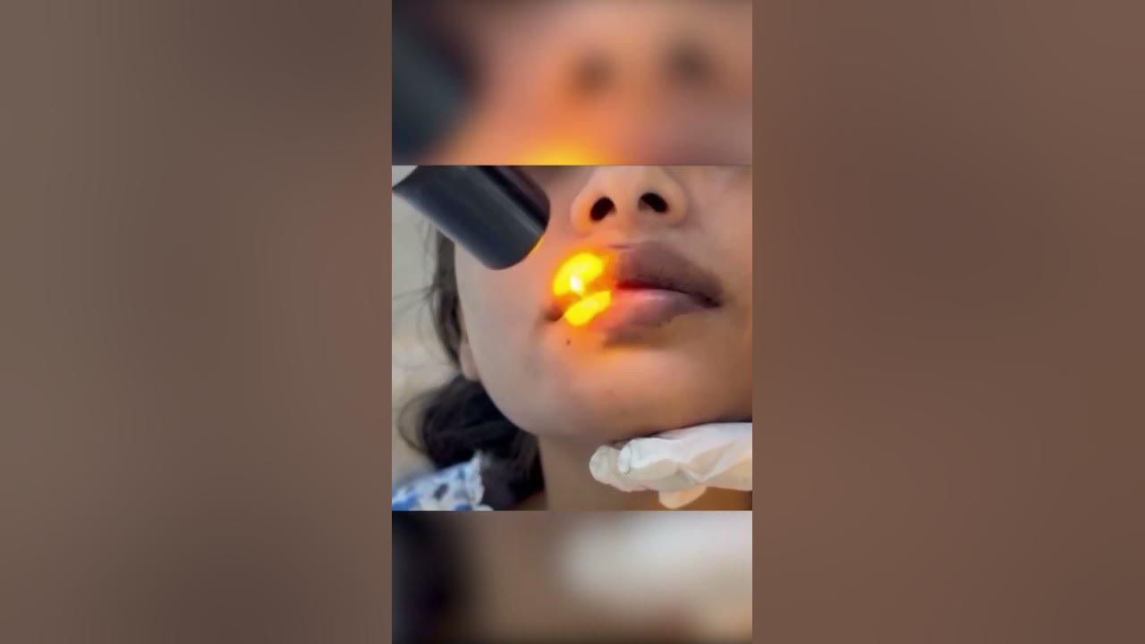 carbon-laser-peal-laser-peel-for-dark-lips-laser-treatment-youtube