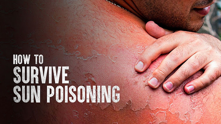How to Survive Sun Poisoning