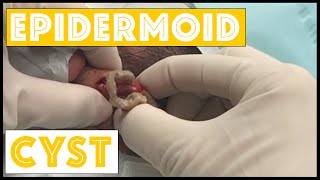 cyst excision on right mandible the wife is a popaholic