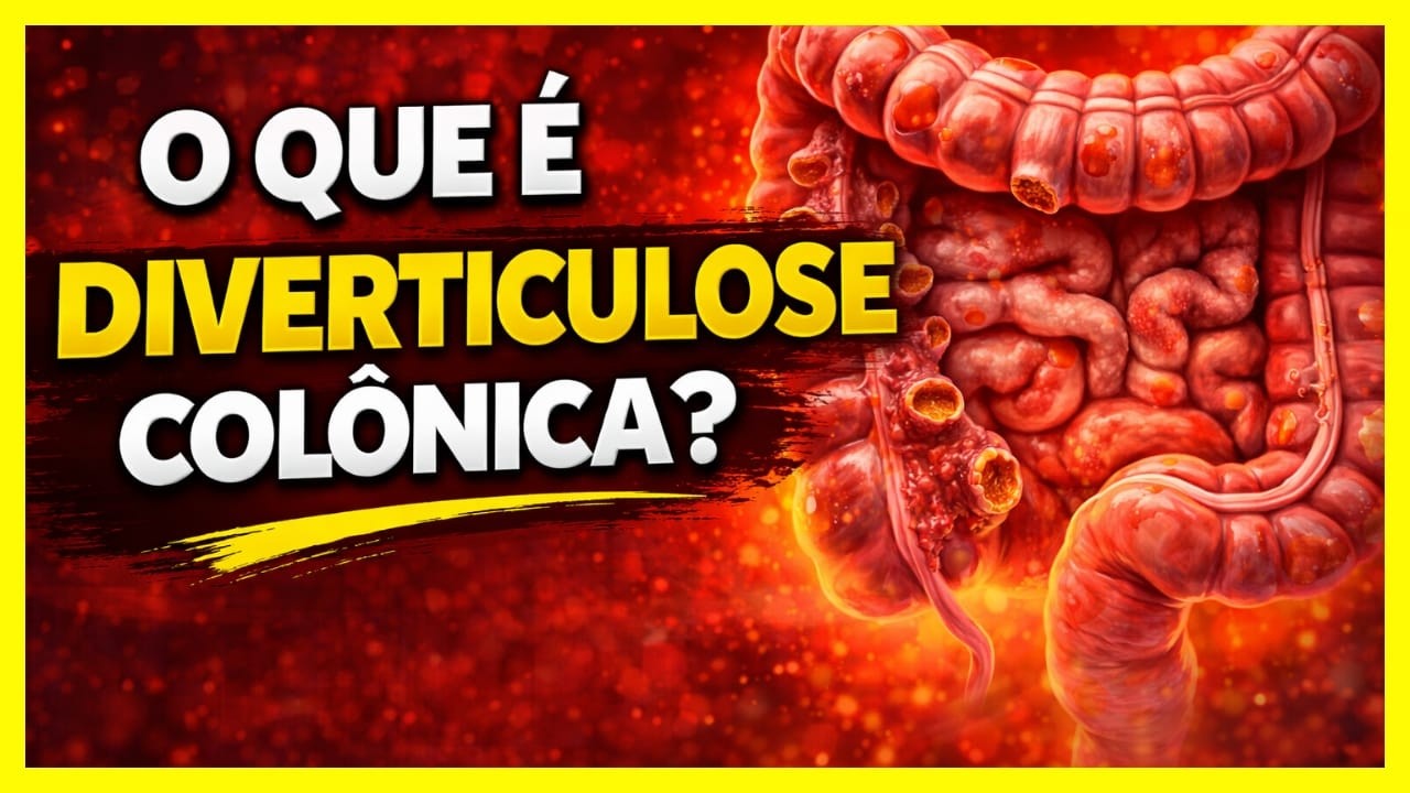 ATENÇÃO: O que é DIVERTICULOSE COLÔNICA e como PREVENIR! DESCUBRA AGORA ...