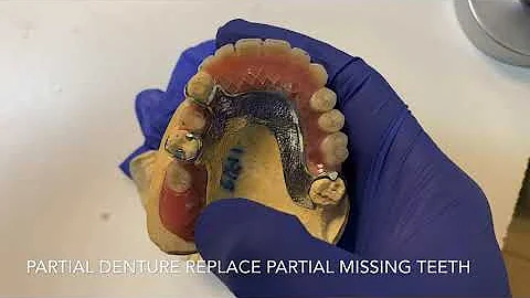 What does a partial denture look like?