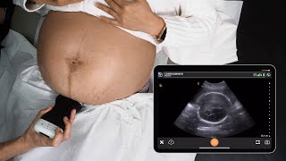 Third Trimester: Locate Fetus and Placenta