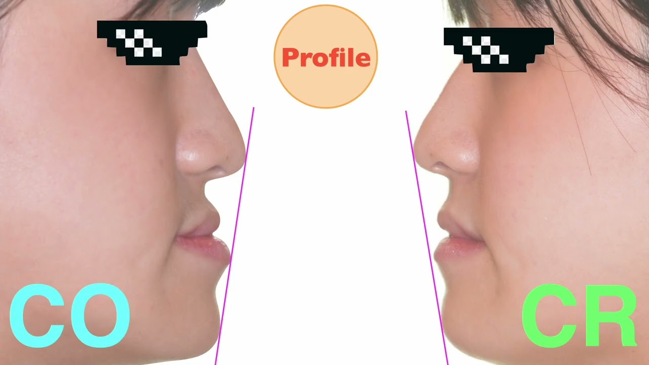 Скелет CIII с прикусом Ant. X | 【Chris Chang Ortho】CC850