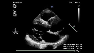 Aortic dissection echocardiography