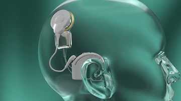 Cochlear™ Nucleus® Nexa™ System - the world’s first and only smart cochlear implant system
