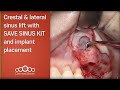 Crestal & lateral sinus lift with SAVE SINUS KIT and implant placement