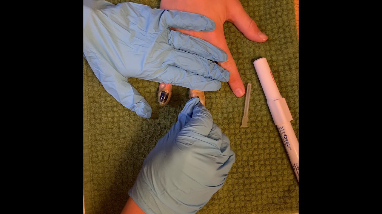 Nail Trephination of Subungual Hematoma YouTube