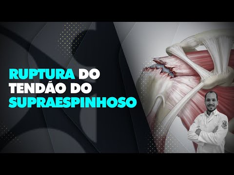 Vídeo: Ruptura De Tendão