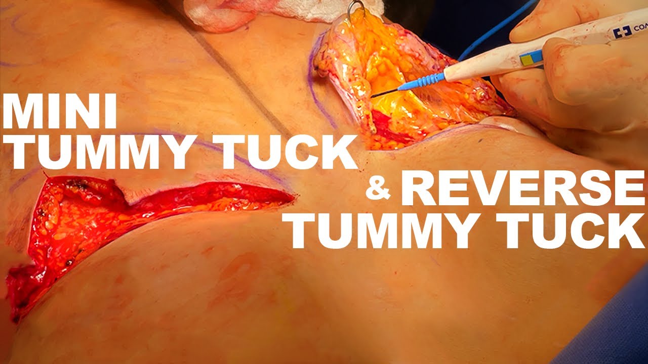What is a reverse tummy tuck? - Dr. Hess
