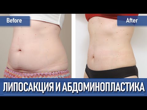 Липосакция и абдоминопластика в Южной Корее | Часть II