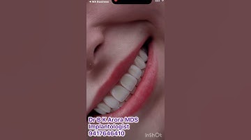Dental Veneers Smile #bestdentist #dentist #smiledesigndental #teeth #doctor #dentalprosthesis