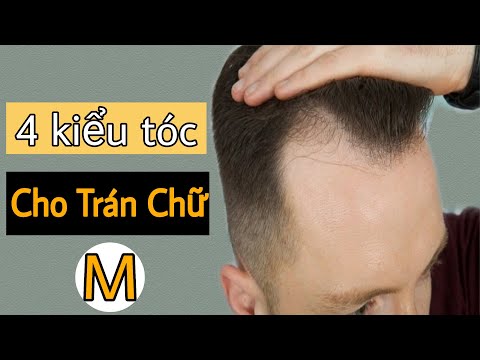 Hội người rụng tóc gây hói đầu   NAM TRÁN CAO TÓC MỎNG PHẢI LÀM NHƯ THẾ  NÀO ĐỂ KHẮC PHỤC   Tóc mỏng trán cao làm cho nam giới