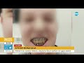 АГРЕСИЯ: Ученик е със счупена челюст след побой от друго дете