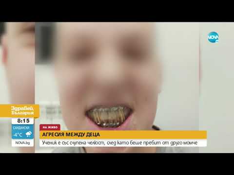 АГРЕСИЯ: Ученик е със счупена челюст след побой от друго дете