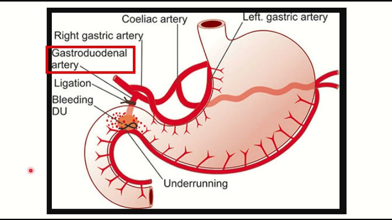 Duodenum Bleeding During PUD MRCS Question Solve CRACK MRCS YouTube duodenum-bleeding-during-pud-mrcs-question-solve-crack-mrcs-youtube