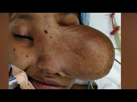 Simaria's HUGE Face Cyst Removal - Case Study