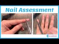 Nail Assessment for Nursing (Normal and Abnormal Findings)