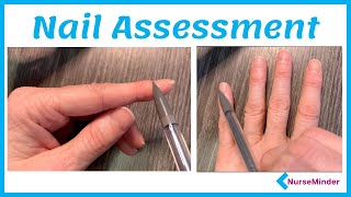 Nail Assessment for Nursing (Normal and Abnormal Findings)