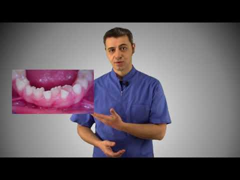 Video: Cosa causa i denti storti?