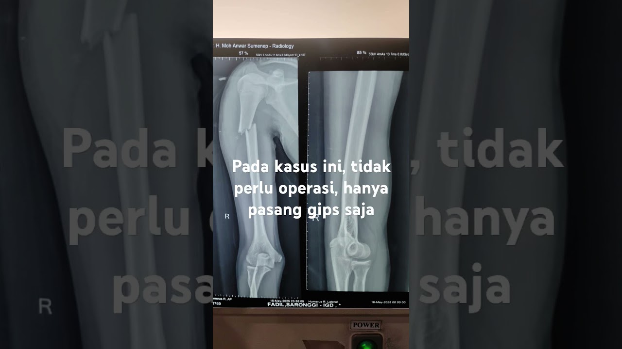 patah tulang lengan pada anak tidak perlu operasi 