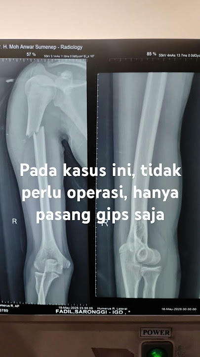 patah tulang lengan pada anak tidak perlu operasi #patahtulang #cedera #anak