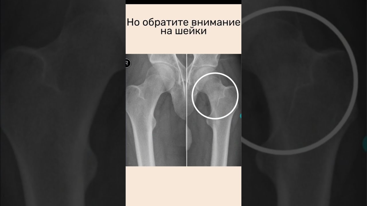 что такое стрессовый перелом