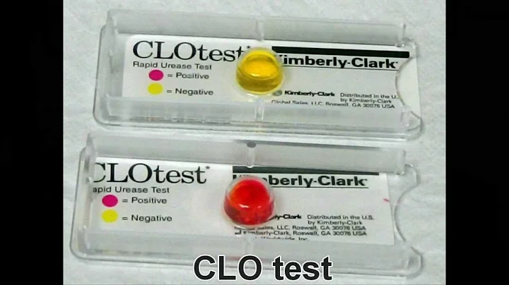 Helicobacter pylori (H.pylori) | Los Angeles Endoscopy