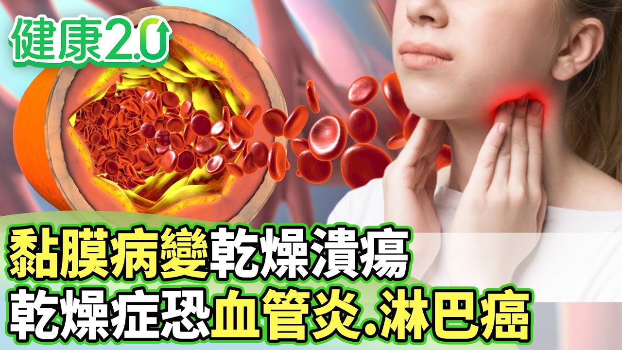 黏膜病變乾燥潰瘍 乾燥症恐血管炎.罹患淋巴癌【健康2.0分段】@tvbshealth20 EP3169-1 20260201 #鄭凱云#盧俊吉#蔡逸姍#吳明珠#洪素卿#林秋香