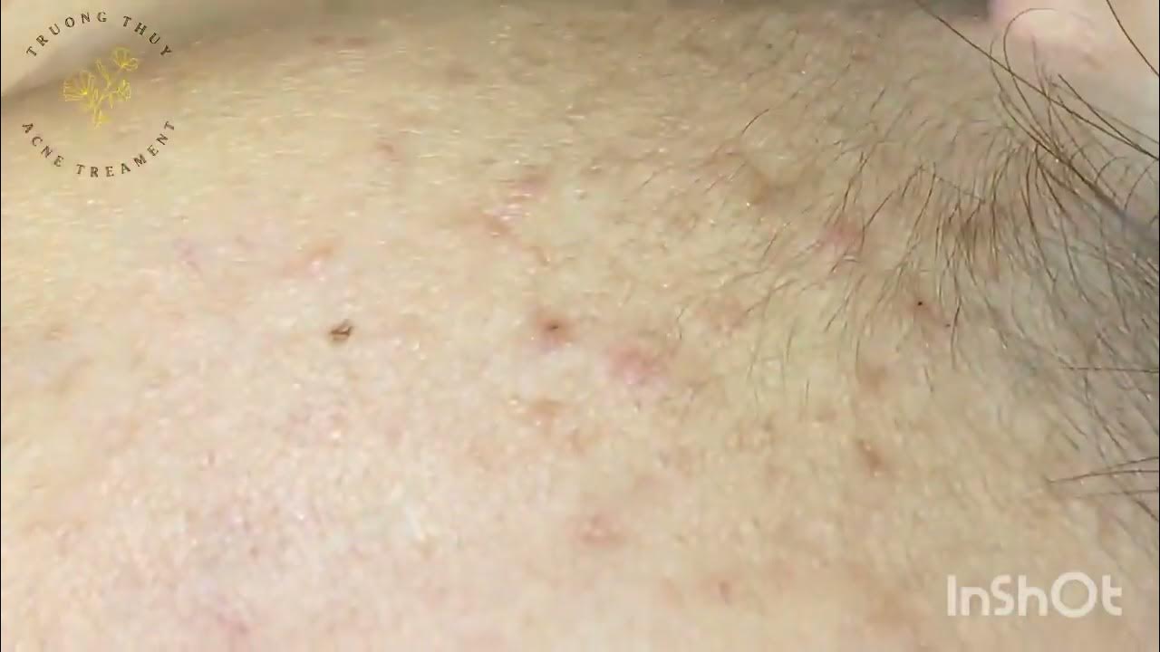 new pimple popping videos blackheads 2023 YouTube