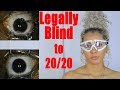 LASIK Surgery Beverly Hills | From Legally Blind to 20/20