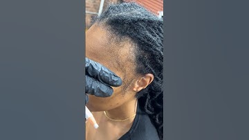 Hairloss Solution for Women? Instant results #scalpmicropigmentation