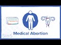Medical Abortion