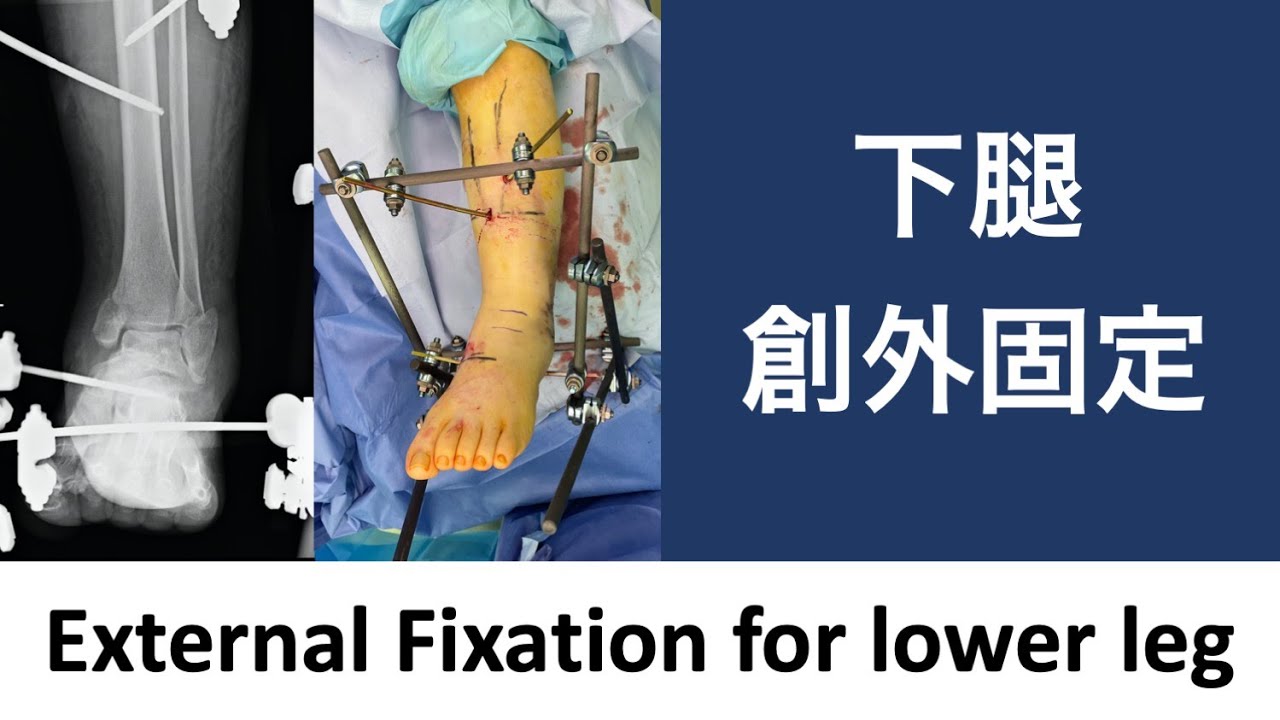 下腿創外固定 external fixation for lower leg【下肢6】 - YouTube