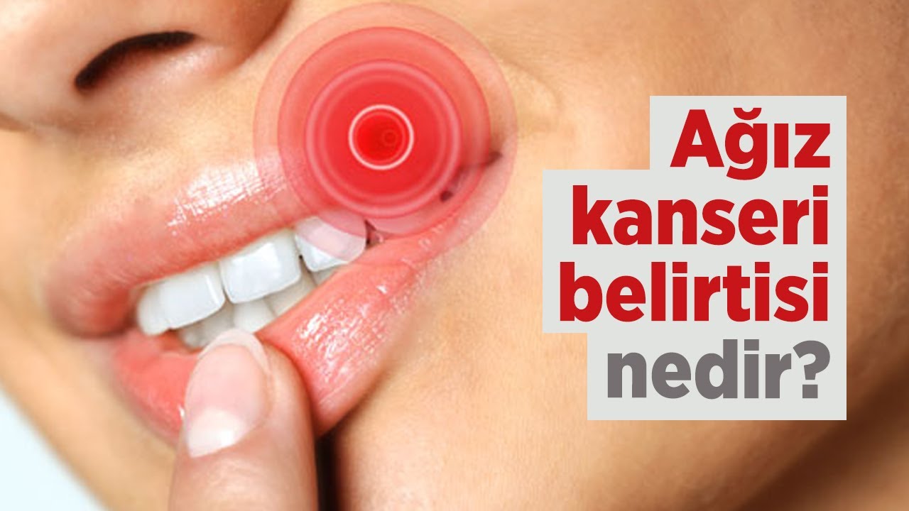 Ağız kanseri belirtisi nedir?
