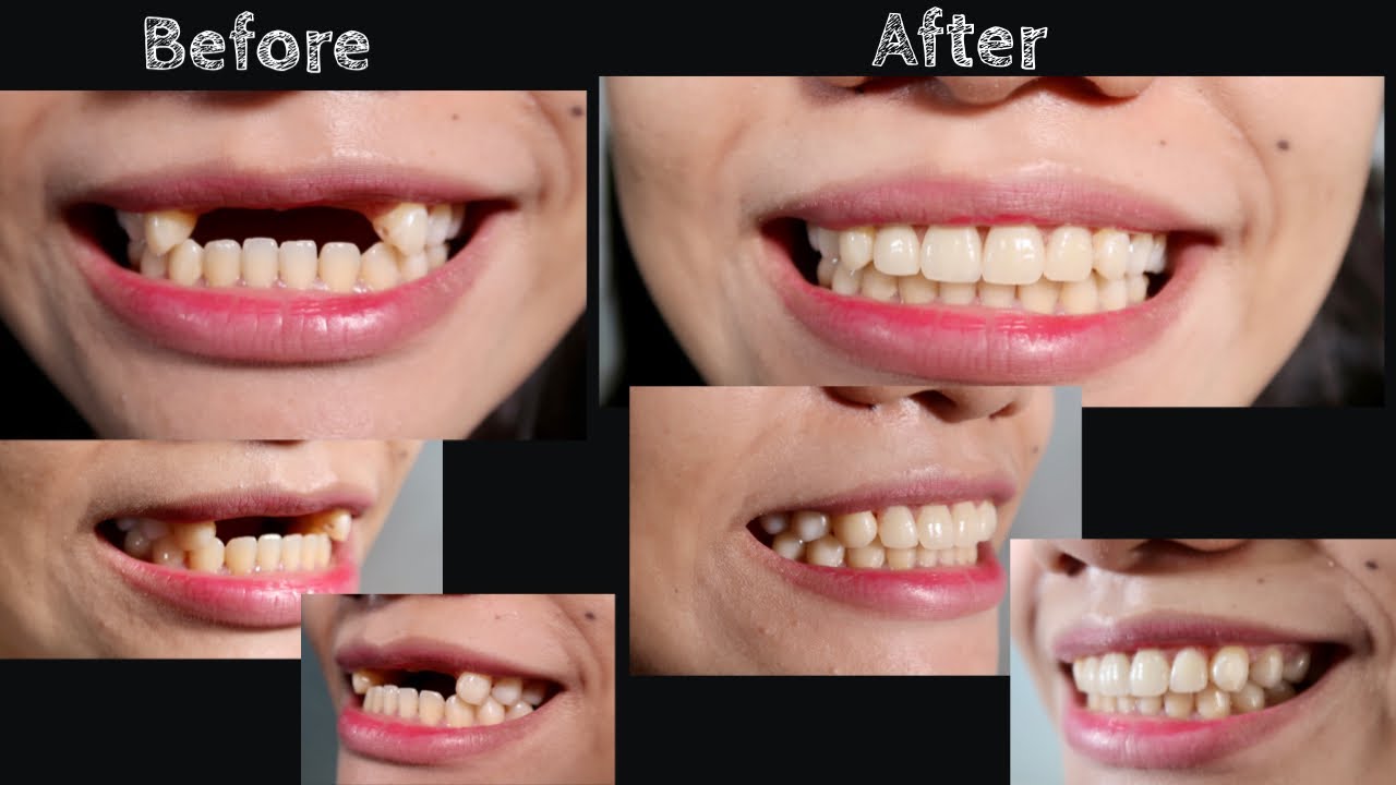 REMOVABLE PARTIAL DENTURE | Doc Noy