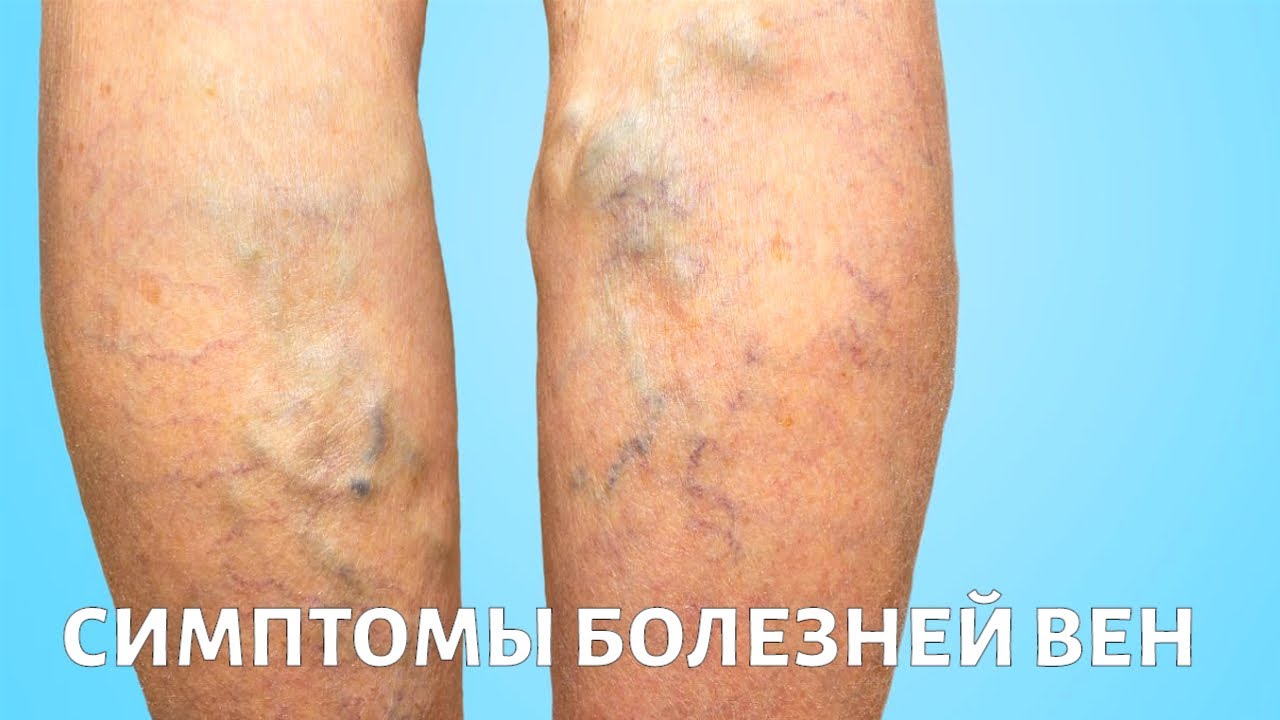 ce sa faci cand te dor varicele dupa intervenia chirurgicala gimnastica varicoasa